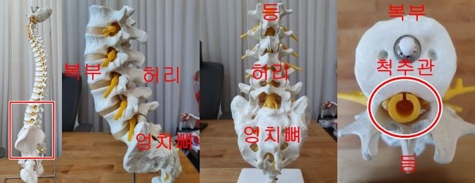 척추관협착증, 허리디스크는 아니라는데, 허리 통증이...